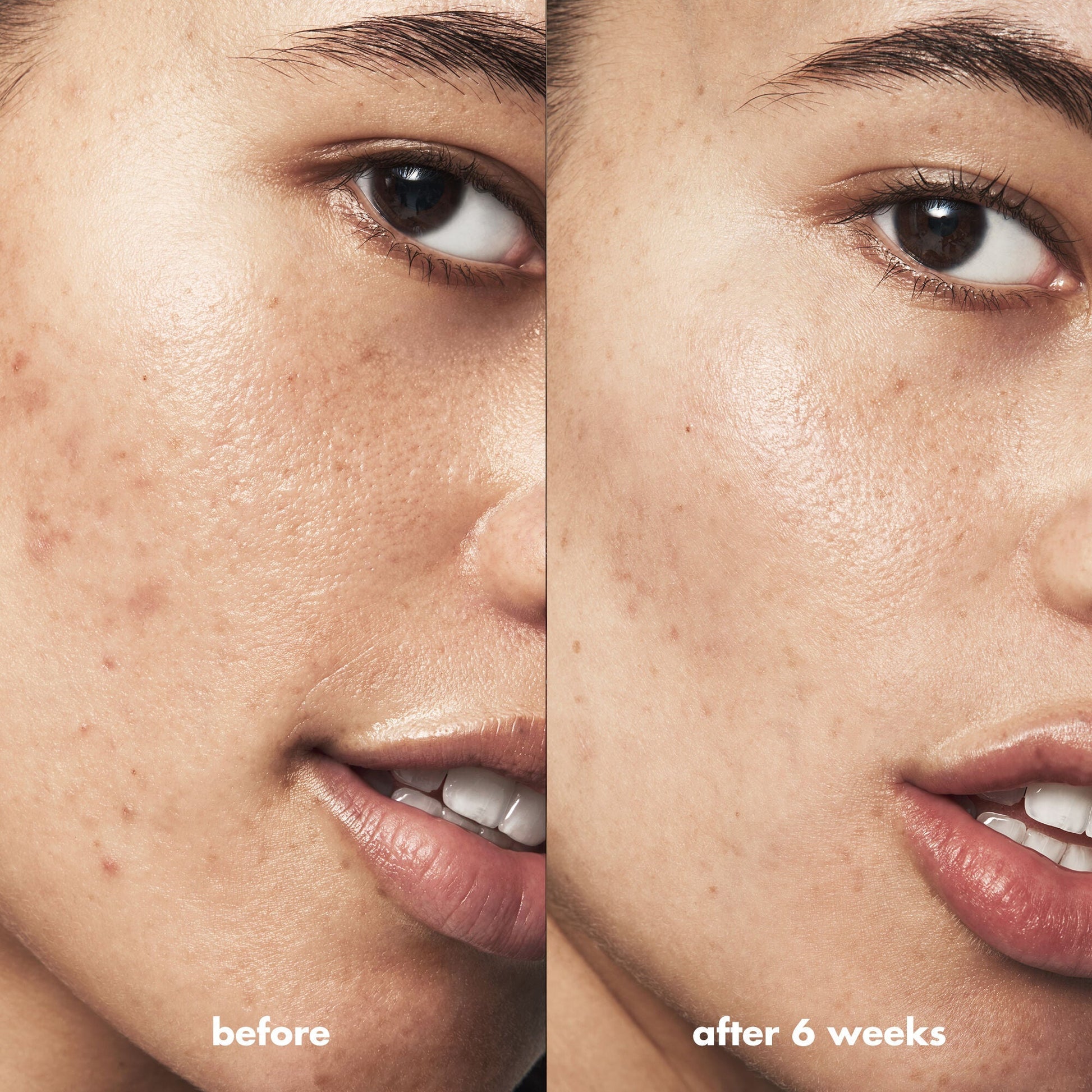 blemish-breakthrough-acne-calming-water-cream-mini-t3 Acne_PDP_Isabella_Before_After_f0d452cd-72f5-4bb8-a6df-0b3cc23143ef.jpg