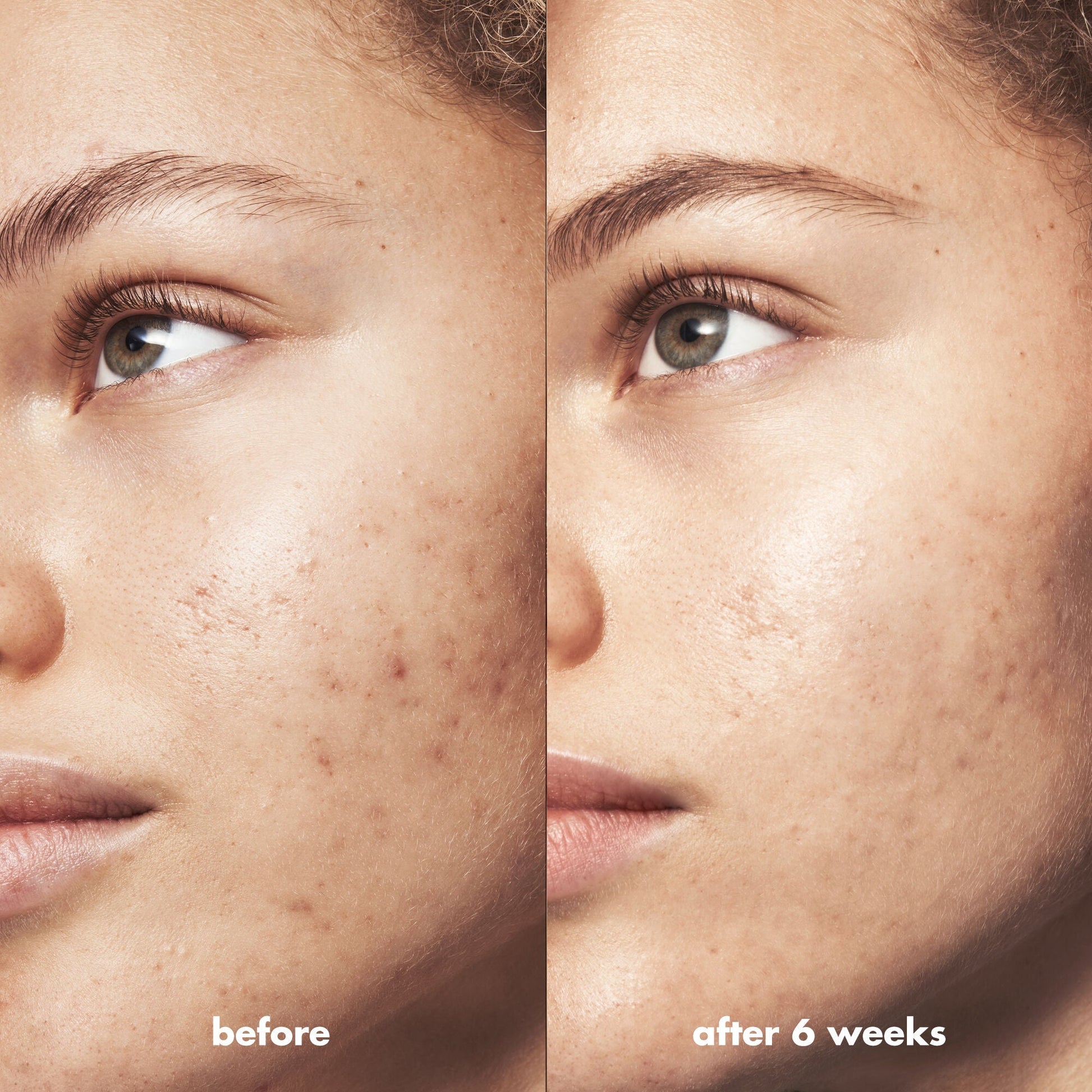blemish-breakthrough-acne-calming-water-cream-n1 Acne_PDP_Marley_Before_After_be0f6ee7-ce12-4695-83d7-5ec5f0498e19.jpg